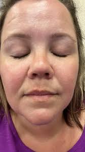 Help Please!!!My 14 years son has got dark pigmentation under his lower  lips.