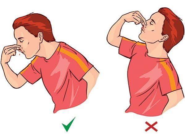 Sơ cứu đúng khi bị chảy máu cam | Vinmec