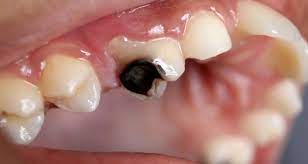 Causes Of Tooth Decay Edmonton Downtown Dentist Cure Tooth Decay Dental Health Tooth Decay