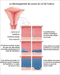 L'adénocarcinome est plus rare et se rencontre dans moins de 20% des cas. Developpement Du Cancer Du Col Cancers Du Col De L Uterus