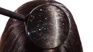 Hair dandruff treatment, balon ki khushki ka ilaj in urdu hindi beauty tips and health tips by memoona muslima a student of naturopathy 2016. Dandruff Treatment In Urdu