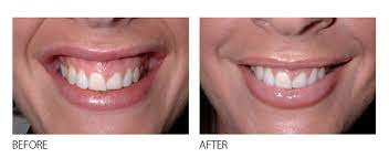 How to fix a gummy smile with braces. Fixing A Gummy Smile Can Be Easier Than You Think Firstbite Dental Essendon Dentist