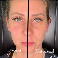 Dermal-Fillers-Baytown, Texas