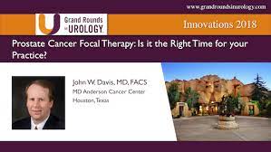 One in seven men in the united states will receive a prostate cancer diagnosis during his lifetime. Jeffrey A Jones Md The Pros Of Focal Therapy For Prostate Cancer
