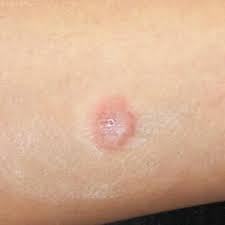 Your doctor may shave off dead skin on the wart area with. Cryotherapy A Beginner S Guide Clinician Reviews