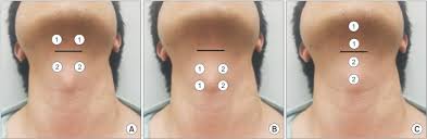 Different Movement Of Hyolaryngeal Structures By Various