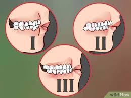 Overbites can be treated by invisalign clear aligners and could be a suitable alternative to clear braces. 3 Ways To Diagnose An Overbite Wikihow