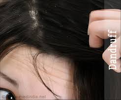 There are several over the counter shampoos that can help with dandruff but if that doesn't work, your dermatologist may be able to help. Hair Dandruff Beauty Tips
