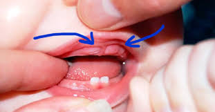 Как отличить болезнь от прорезывания зубов? Kak Vyglyadit Prorezyvanie Molochnyh Zubov Neskolko Foto Vseh Etapov Stomatolog Egor Shetinkin Yandeks Dzen