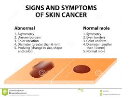 signs and symptoms of skin cancer stock vector