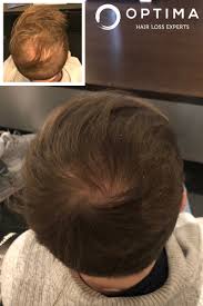Depending on what's causing your lady locks to thin or fall out, there are a variety of options to help women with you can also invest in hair pieces and accessories, a wig, or choose to own your hair loss. Laser Hair Growth Treatment Laser Therapy Birmingham Optima Hair