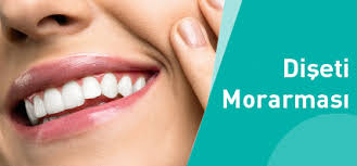 dis etinin morarmasi normal midir dentway dental clinics