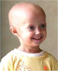 Image result for progeria case in bihar