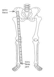 Image result for Functional Leg Length Discrepancy