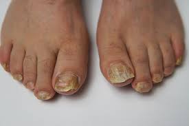 Image result for onychomycosis