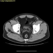 Image result for Nephrolithiasis Imaging