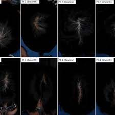 Ok so ive just finished off my first cycle of test prop and dbol(6 weeks). Pdf The Efficacy And Safety Of 17 Alpha Estradiol Ell Cranell R Alpha 0 025 Solution On Female Pattern Hair Loss Single Center Open Label Non Comparative Phase Iv Study
