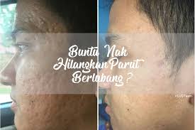 Mengubati parut jerawat biasanya bergantung kepada tahap dan lokasi parut anda. Cara Mudah Hilangkan Parut Jerawat Berlubang Vitamin Sihat