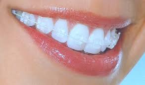 Jenis behel untuk gigi gingsul. 10 Hal Wajib Tau Sebelum Pasang Behel Gigi Orange Dental