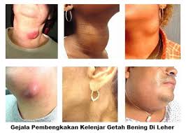 Kanker kelenjar getah bening atau limfoma merupakan kanker yang berkembang di jaringan kelenjar getah bening atau kelenjar limfa. Kenapa Saya Mempunyai Satu Kelenjar Getah Bening Yang Membengkak Galena