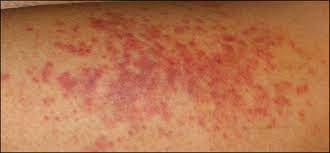 The spots may also appear on organs or mucous membranes, including the. A Purpuric Rash And Mononeuritis Multiplex Photo Quiz American Family Physician