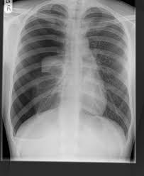 A pneumothorax is a collection of air outside the lung but within the pleural cavity. Re Expansion Pulmonary Oedema In Pneumothorax Bmj Case Reports
