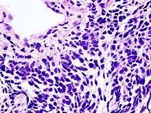 Stine hangaard, msc, from the department of health science and technology at aalborg university in denmark, spoke with pulmonary advisor about the important findings of the study. Small Cell Carcinoma Wikipedia