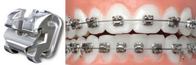 We did not find results for: Types Of Braces Orthodontist Cape Town Dr S Shaboodien Orthodontist Cape Town Dr S Shaboodien