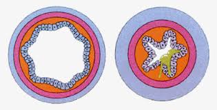 Normal vs Asthmatic Bronchial Tubes