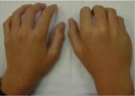 Aka = intellectually destitute fracture a fracture of the forth or fifth metacarpal neck with volar displacement of the metacarpal head. The Weekend S Regrettable Break Boxer S Fracture The Healthy Body Company