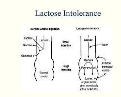 Image result for Lactase Deficiency