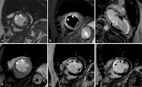 Myocarditis is an uncommon disorder. Klinischer Nutzen Einer Kardio Mrt Untersuchung Bei Patienten Mit Akutem Myokardinfarkt Springerlink