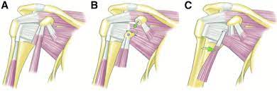What is conjoint tendon, function, definition, location and processes. A Native Shoulder B Latarjet Procedure The Coracoid Graft Download Scientific Diagram