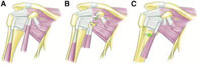 Webmd's shoulder anatomy page provides an image of the parts of the shoulder and describes its the shoulder is one of the largest and most. A Native Shoulder B Latarjet Procedure The Coracoid Graft Download Scientific Diagram