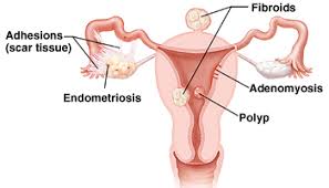 Endometriosis, composed of functional layers). Problems Laparoscopic Hysterectomy Can Treat Saint Luke S Health System