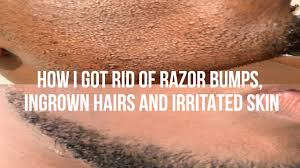 They occur when cut hairs start to grow back down into the skin rather than growing out above. How I Got Rid Of Razor Bumps And Ingrown Hairs Youtube