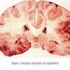 Multilocularis, and describes a spectrum of disease involving the spinal cord, the spine, or both. Https Encrypted Tbn0 Gstatic Com Images Q Tbn And9gct5jfajlkeyq2u1fay1duqtu Onl6fe J6trwxmzlfbh Icddbr Usqp Cau