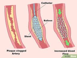 Ua/nstemi guidelines make recommendations regarding the diagnosis and treatment of patients with known or suspected cardiovascular disease (cvd). How To Treat Nstemi With Pictures Wikihow