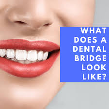 The american academy of implant dentistry says that 3 million americans have dental implants, and that number is growing by 500,000 every year. What Does A Dental Bridge Look Like Mccartney Dental North Port Fl