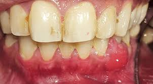 Image result for granuloma gum disease