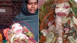 Shop over 7,900 top pleated skirt and earn cash back all in one place. Harlequin Ichthyosis Mother Abandons Baby With Shell Like Skin