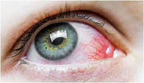 We did not find results for: Mucormycosis Or Black Fungus Infection Causes And Symptoms Medipulse Best Private Hospital In Jodhpur
