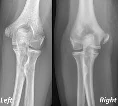 Image result for Elbow XRay
