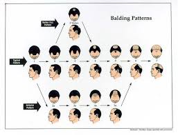 Some types of hair loss are permanent, like male and female pattern baldness. Male Androgenetic Alopecia Endotext Ncbi Bookshelf