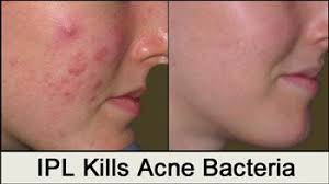 Ipl Photofacial At Body Beautiful Spa In Phoenix Acne Cure Ipl Photofacial Beauty Procedures