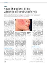 If you have rosacea, talk to your dermatologist about soolantra cream. Rosacea Neues Therapieziel Ist Die Vollstandige Erscheinungsfreiheit