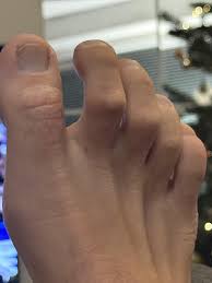 Image result for Clubbing nails feet
