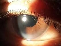 Image result for what is treatment for posterior subcapsular cataract