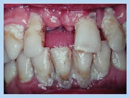 Image result for Periodontitis