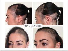 Pin On Hair Loss Tips